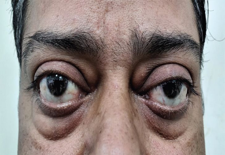 Bilateral proptosis suggestive of thyroid ophthalmopathy.